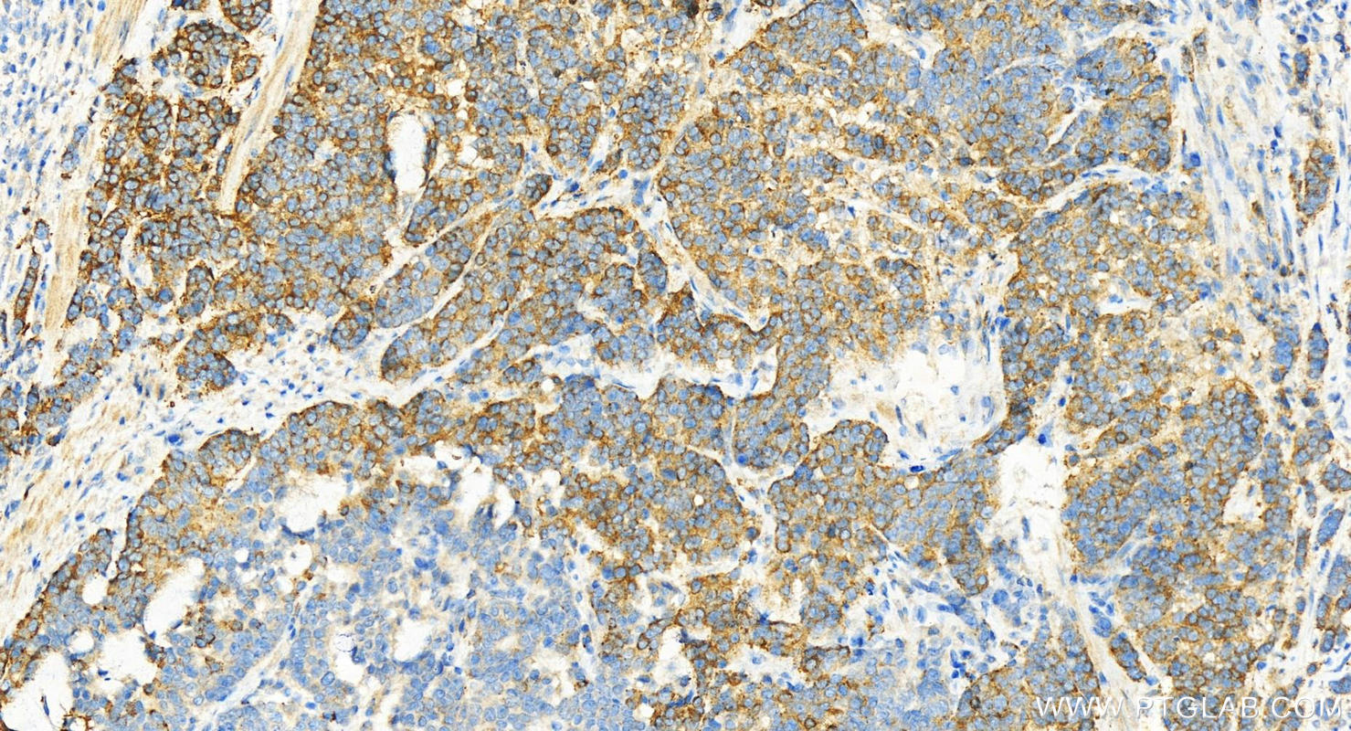 IHC staining of human stomach cancer using 14190-1-AP