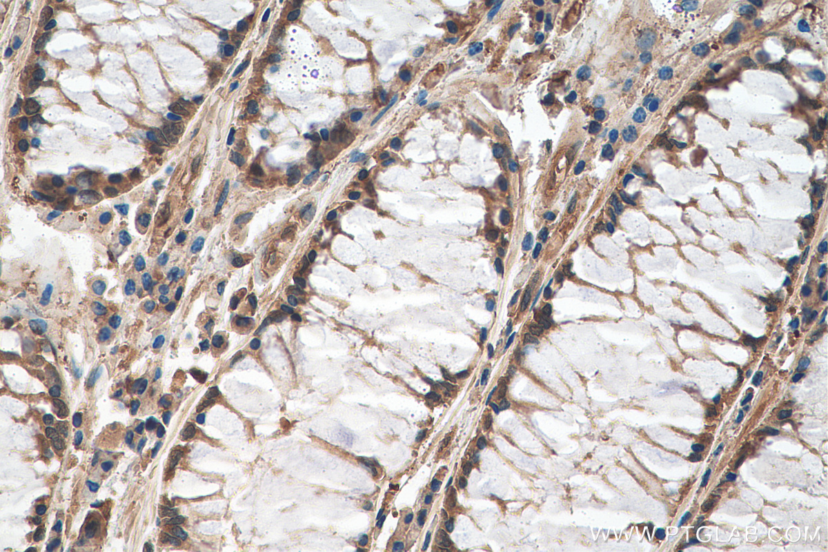 IHC staining of human colon cancer using 29424-1-AP (same clone as 29424-1-PBS)