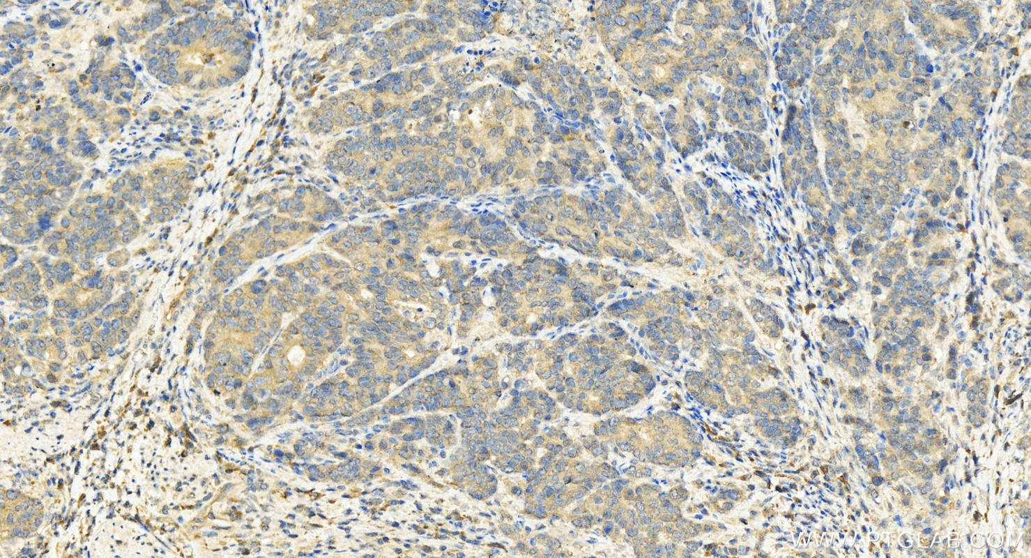 IHC staining of human stomach cancer using 12554-2-AP