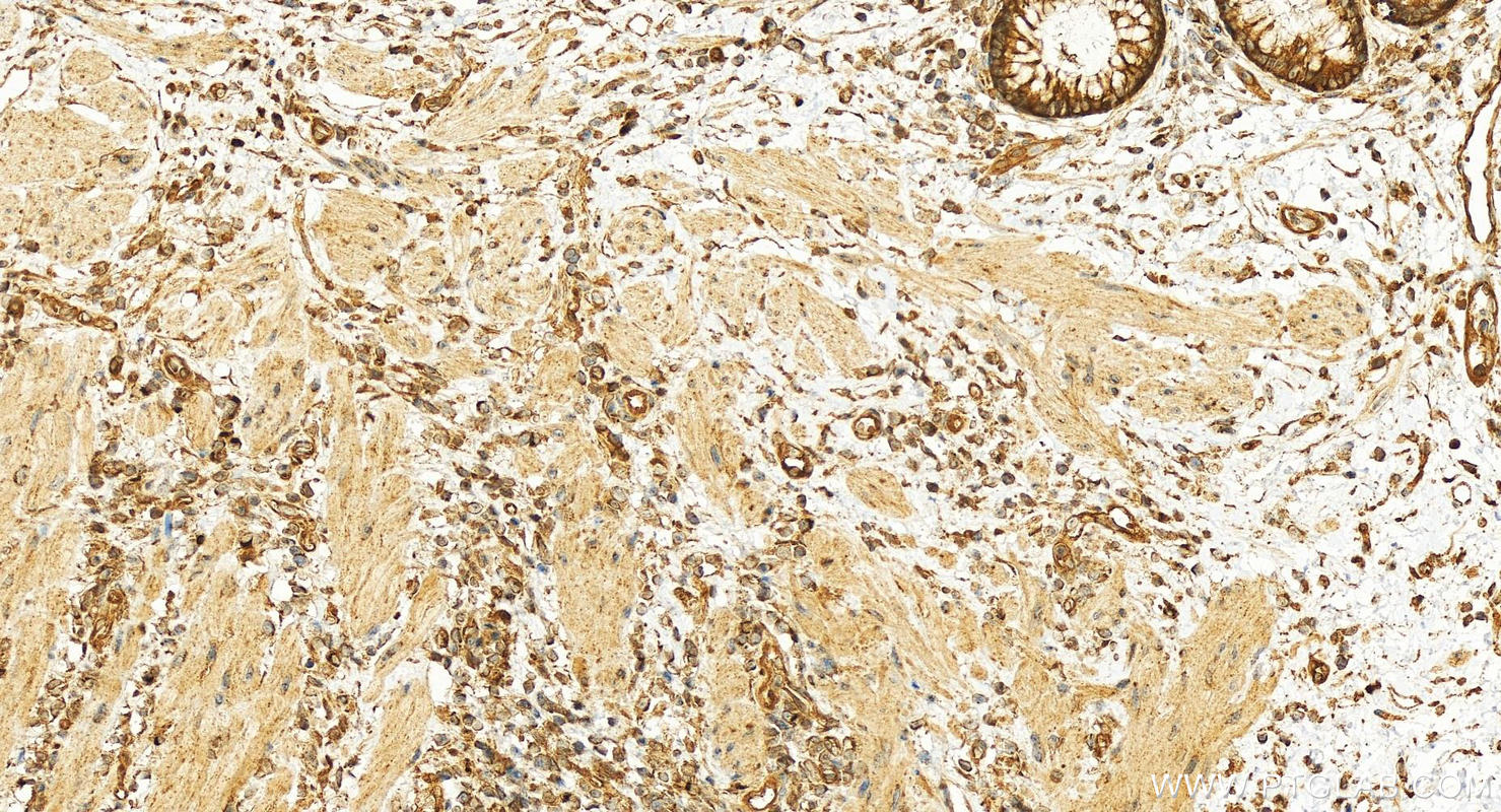 IHC staining of human colon cancer using 13422-1-AP