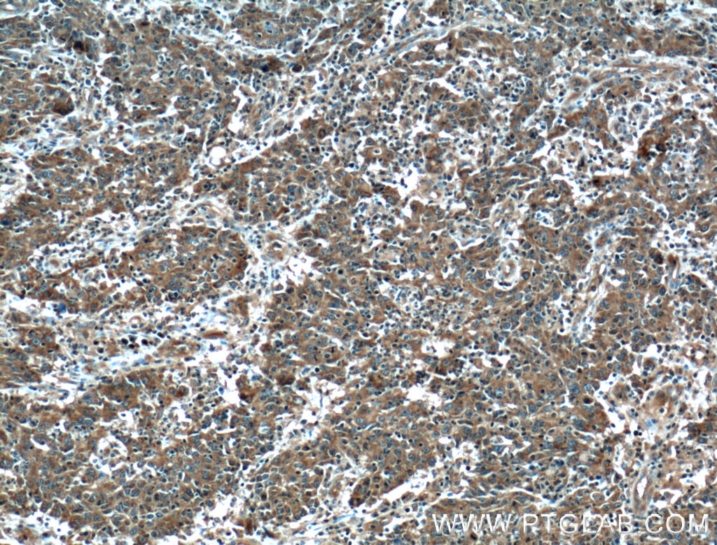 IHC staining of human colon cancer using 13422-1-AP