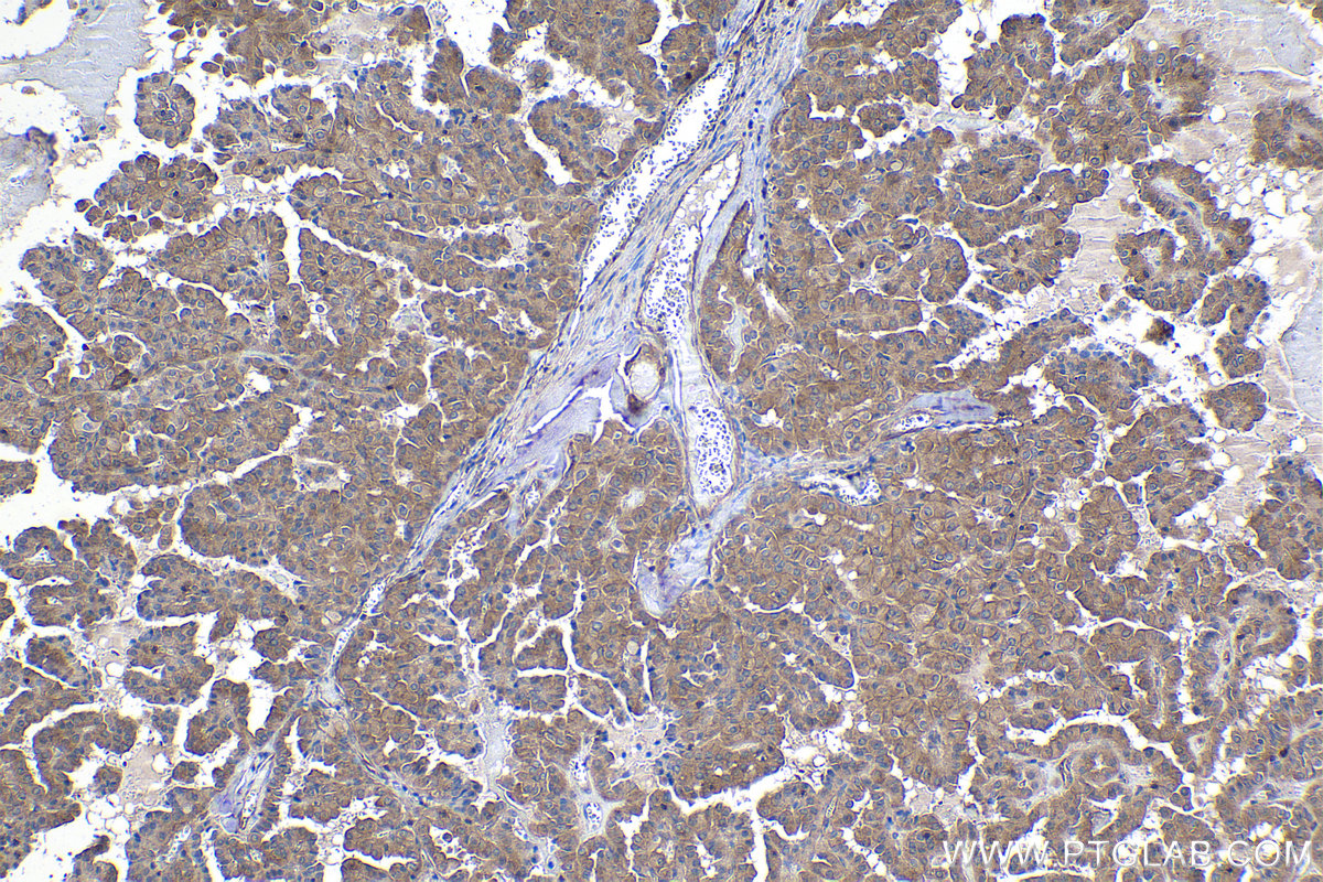 IHC staining of human thyroid cancer using 68163-1-Ig (same clone as 68163-1-PBS)