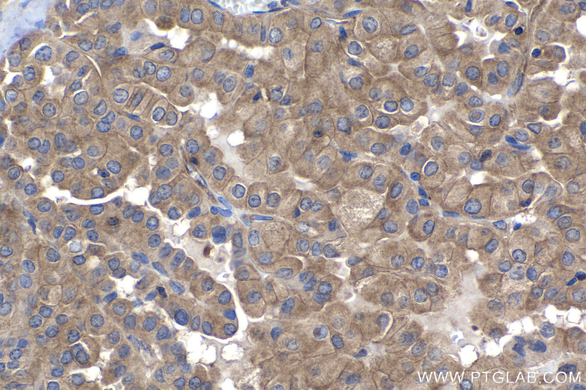 IHC staining of human thyroid cancer using 68163-1-Ig (same clone as 68163-1-PBS)