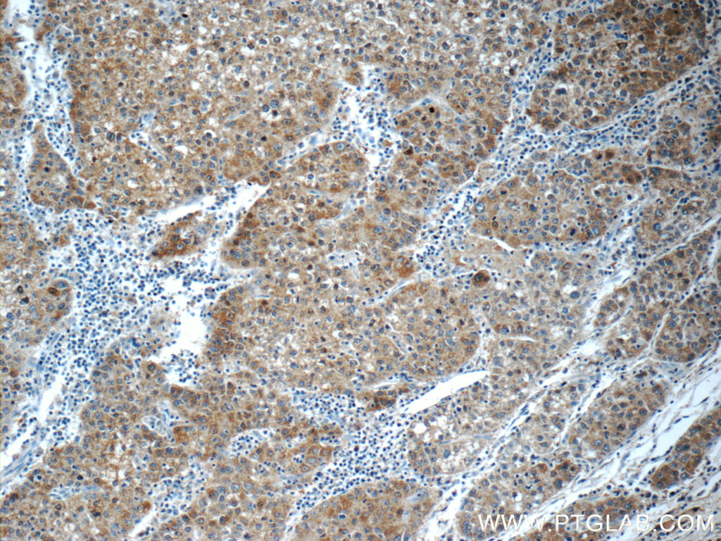 IHC staining of human liver cancer using 22676-1-AP