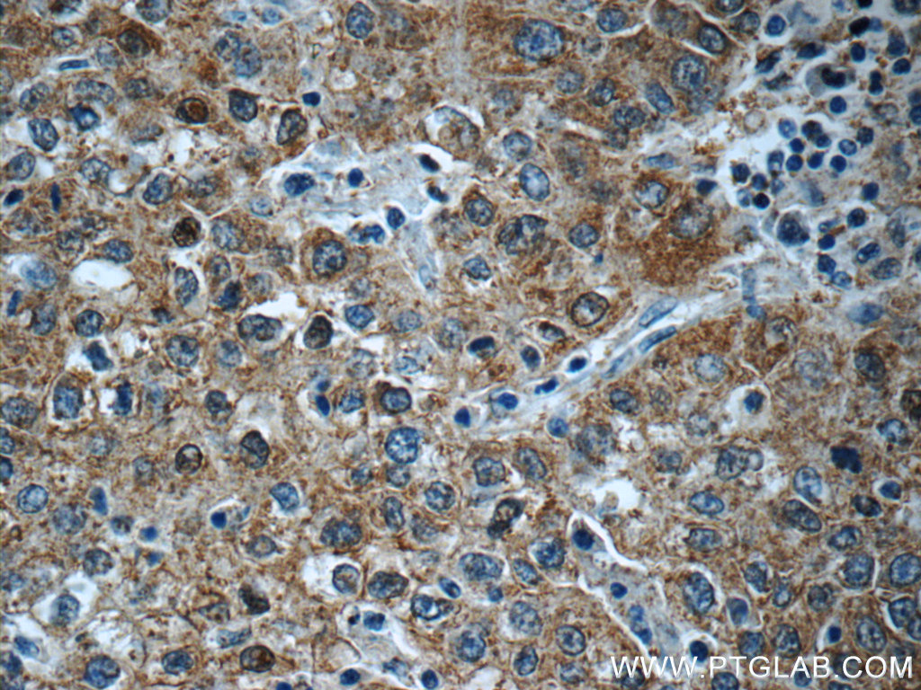 IHC staining of human liver cancer using 22676-1-AP