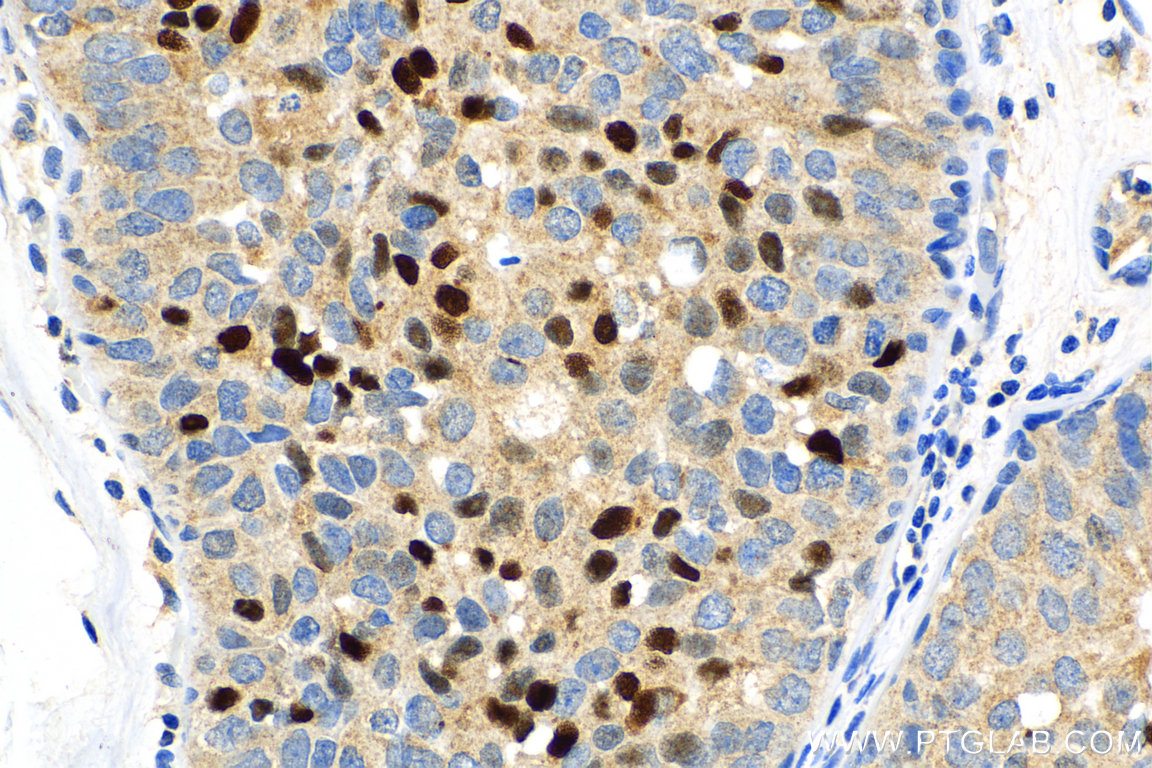 IHC staining of human breast cancer using 25871-1-AP