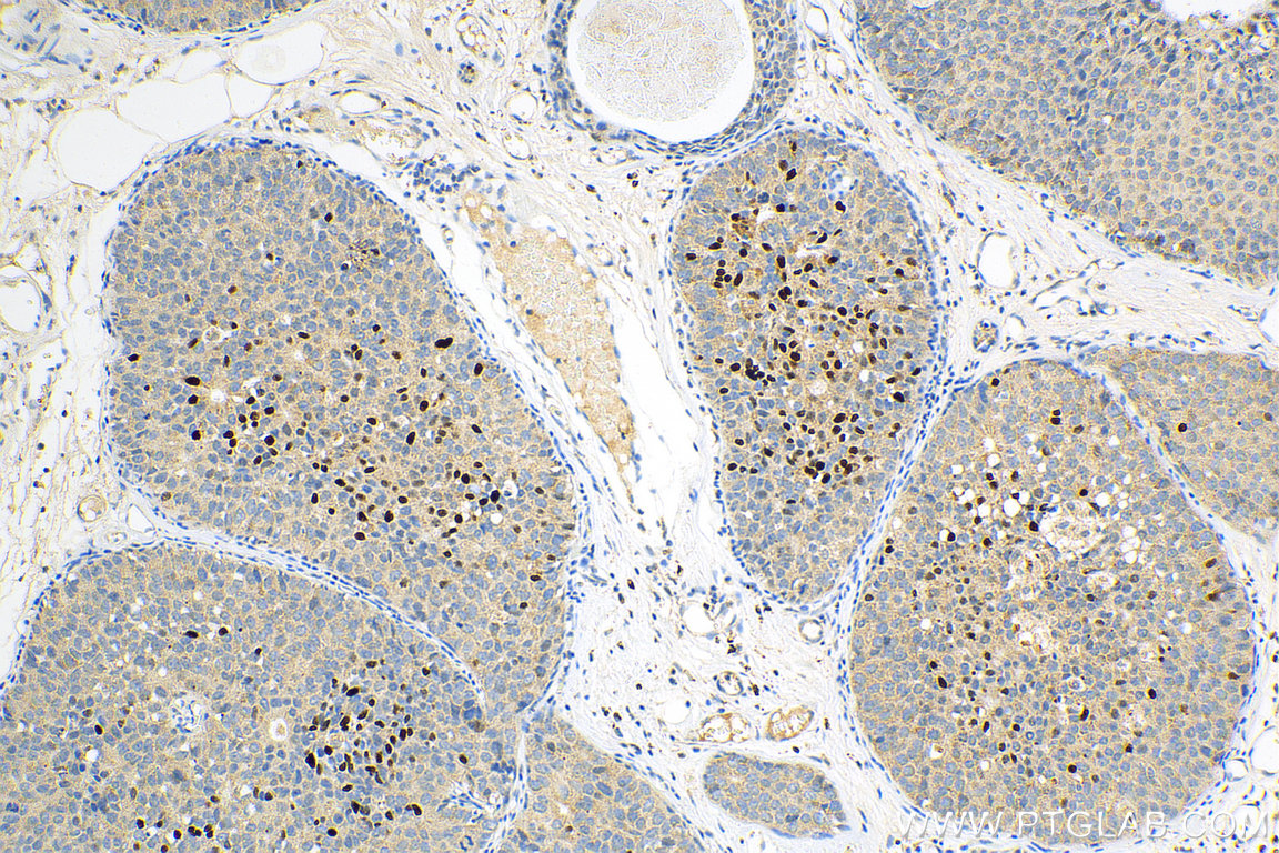 IHC staining of human breast cancer using 25871-1-AP