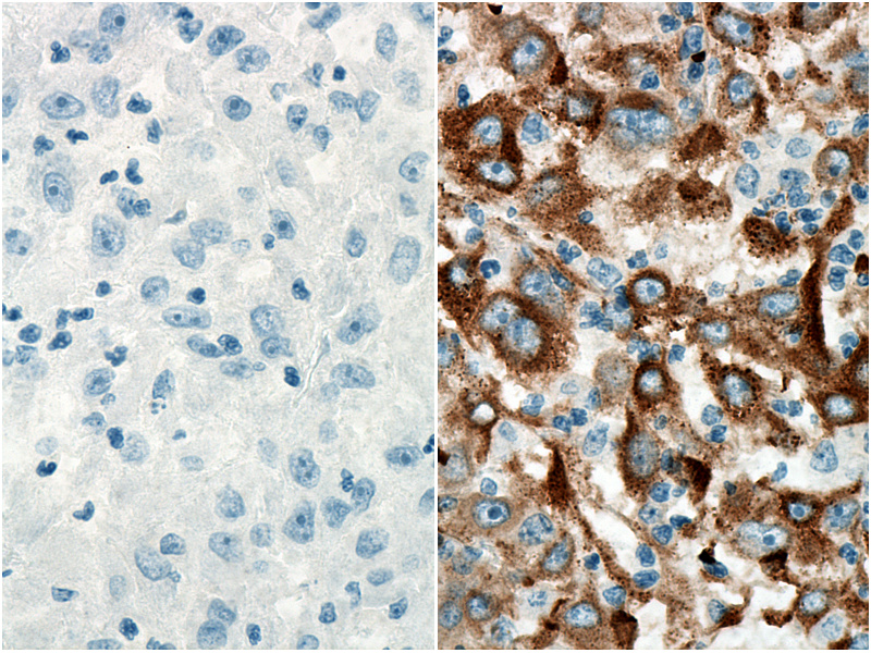 Immunohistochemistry analysis of paraffin-embedded human liver cancer tissue slide using PR30012 without (left) or with (right) primary antibody. 
