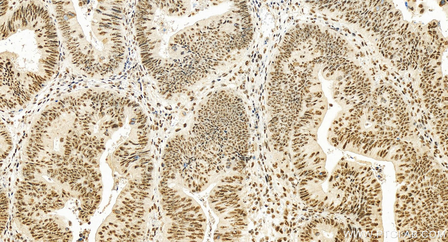 IHC staining of human colon cancer using 14126-1-AP