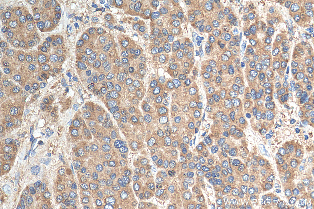 IHC staining of human liver cancer using 55087-1-AP