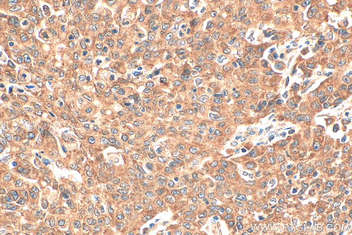 IHC staining of human stomach cancer using 55087-1-AP