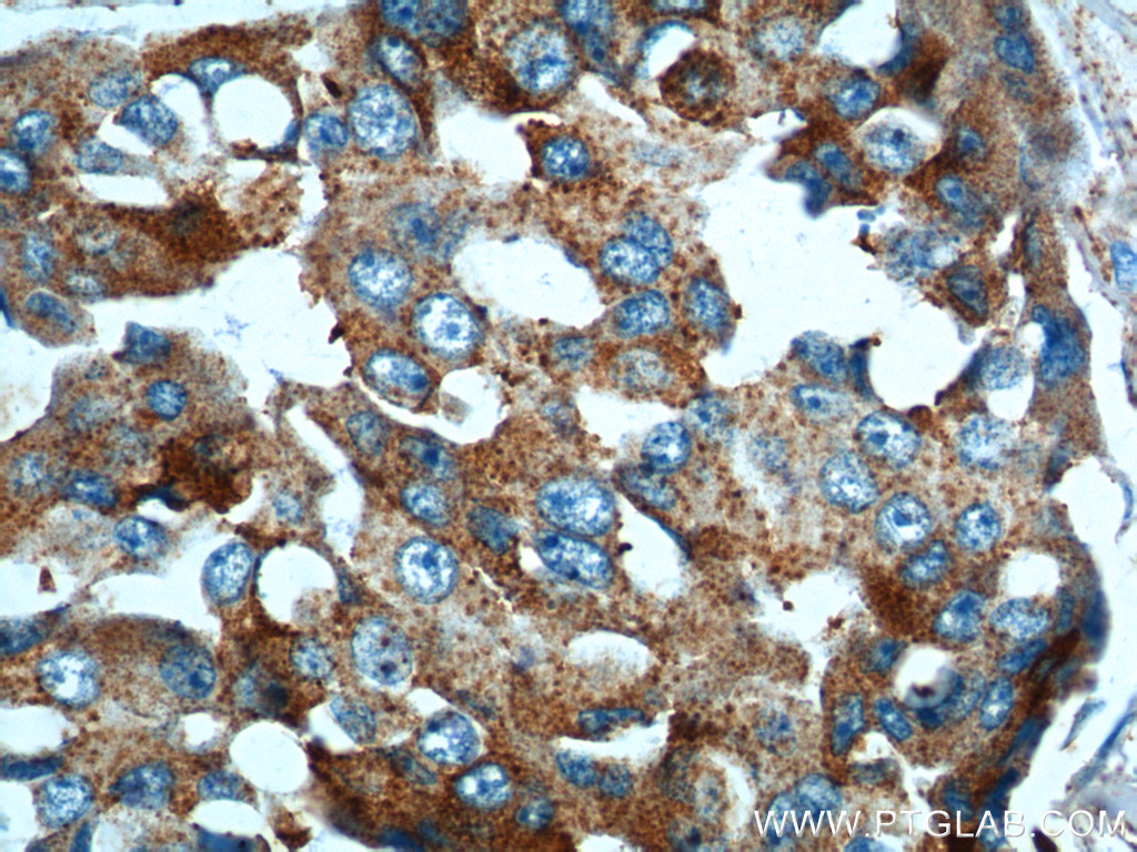 IHC staining of human breast cancer using 10877-1-AP