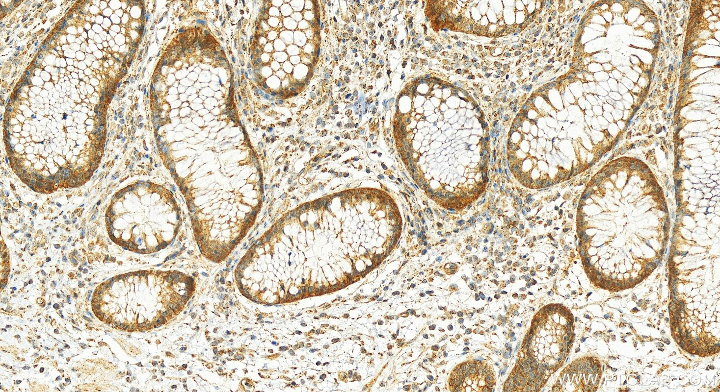 IHC staining of human colon cancer using 11536-1-AP