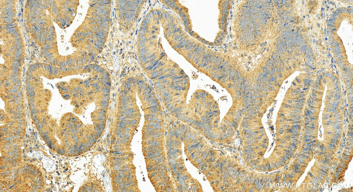 IHC staining of human colon cancer using 11536-1-AP