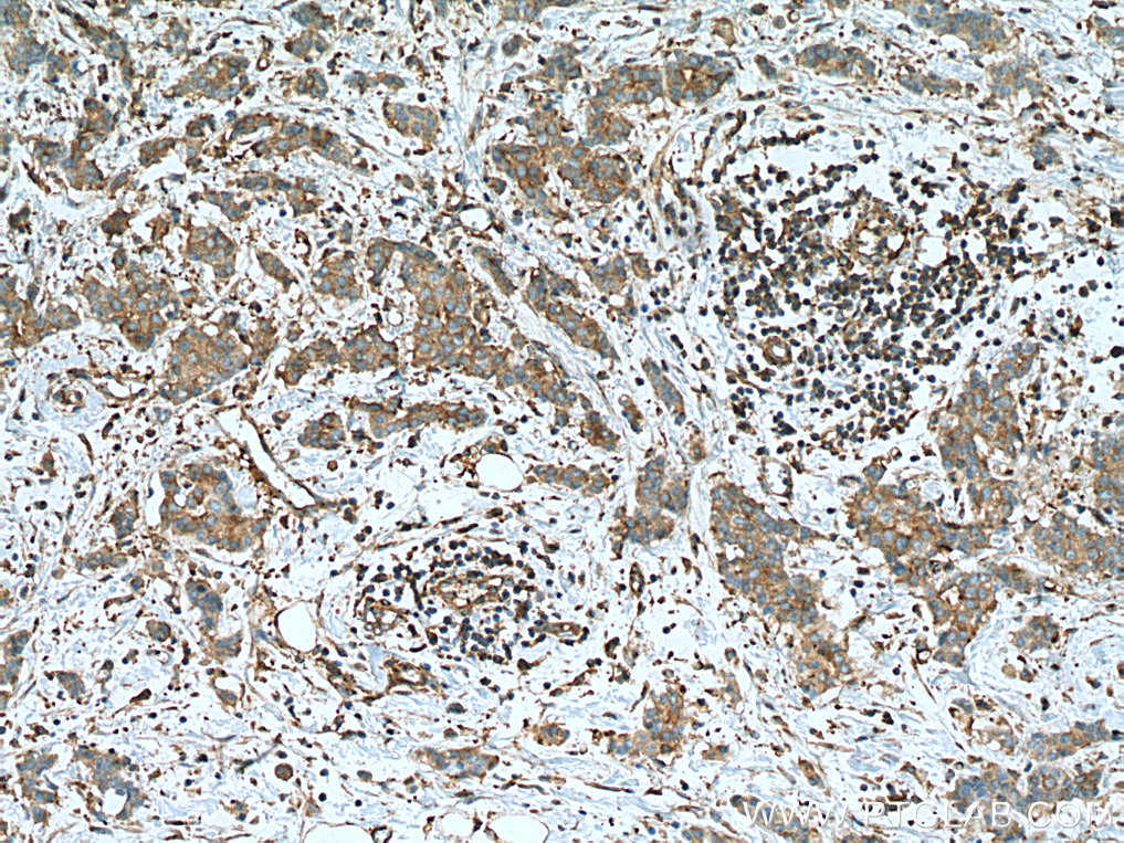 IHC staining of human breast cancer using 67491-1-Ig (same clone as 67491-1-PBS)