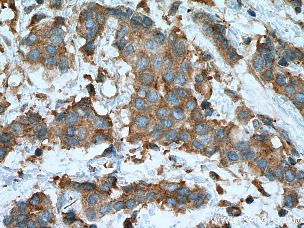 IHC staining of human breast cancer using 67491-1-Ig (same clone as 67491-1-PBS)