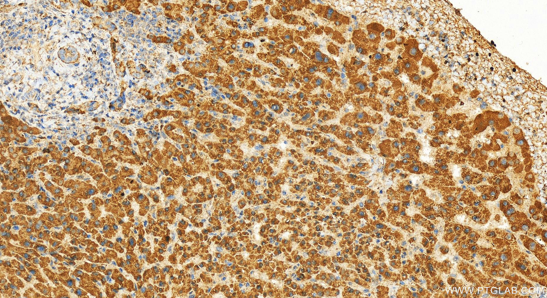 IHC staining of human intrahepatic cholangiocarcinoma using 12568-1-AP