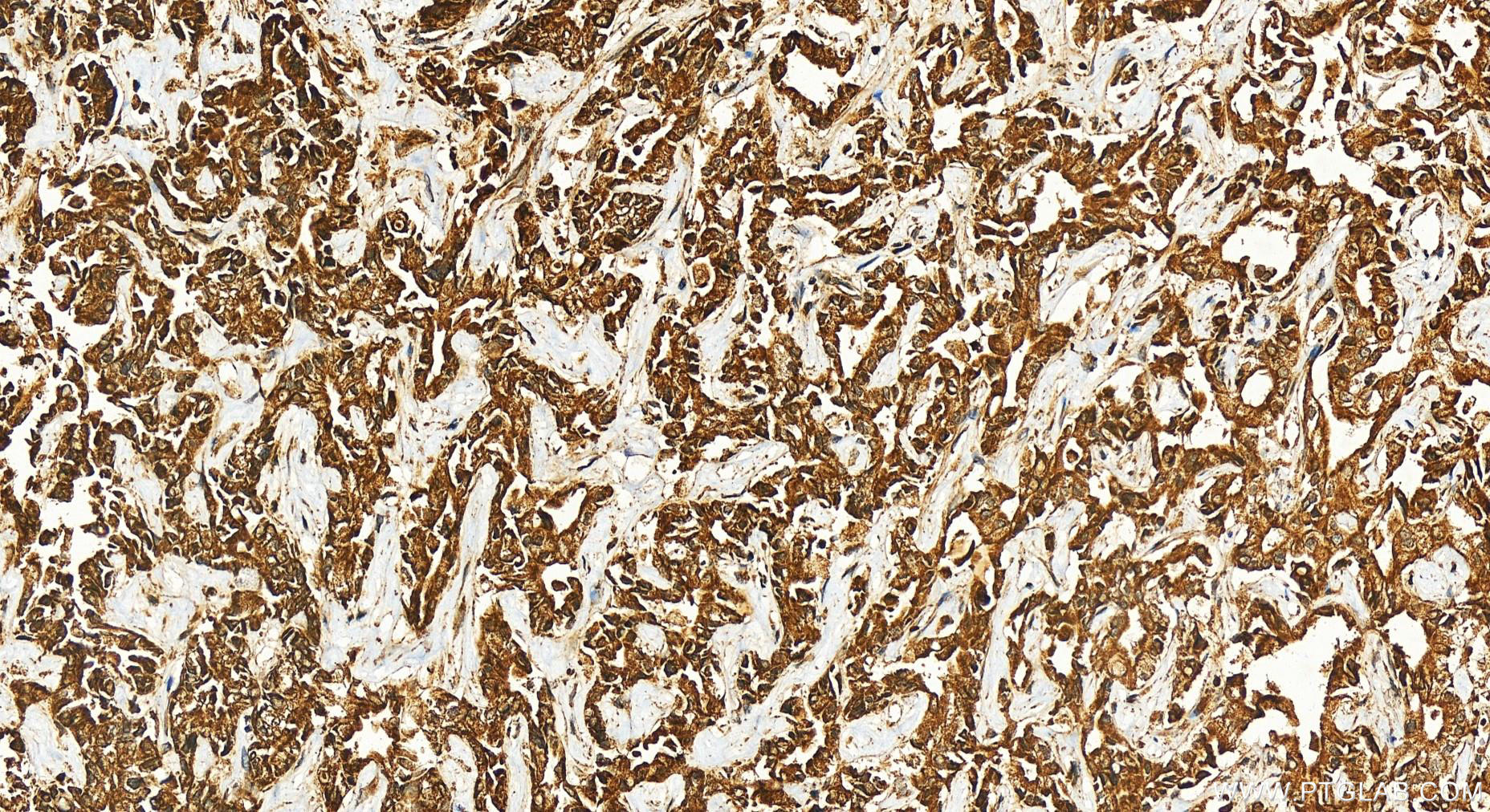 IHC staining of human intrahepatic cholangiocarcinoma using 12568-1-AP