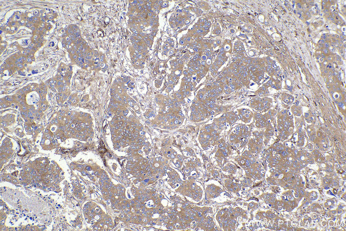 IHC staining of human stomach cancer using 20358-1-AP