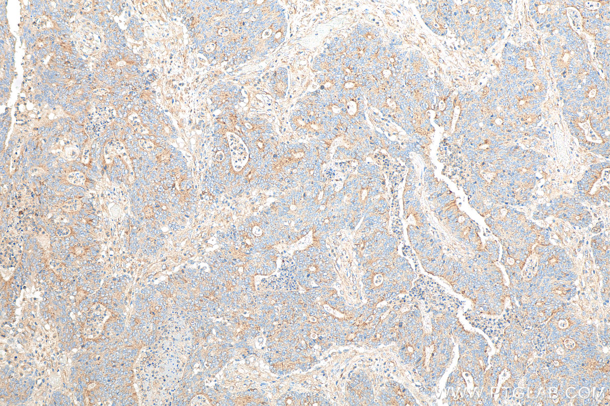 IHC staining of human colon cancer using 67751-1-Ig (same clone as 67751-1-PBS)