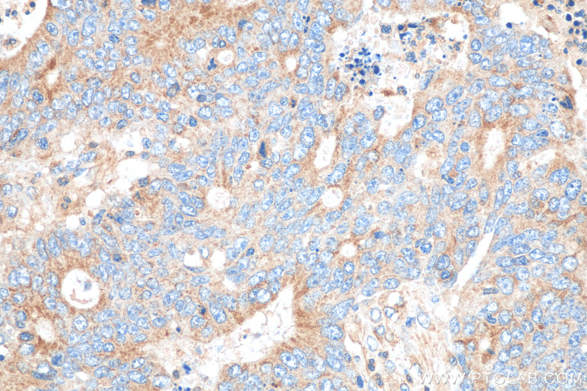 IHC staining of human colon cancer using 67751-1-Ig (same clone as 67751-1-PBS)