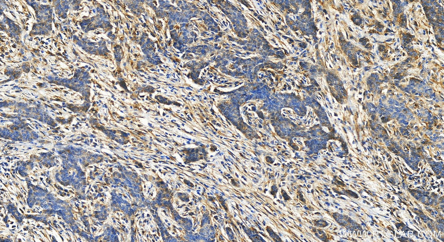 IHC staining of human stomach cancer using 20845-1-AP