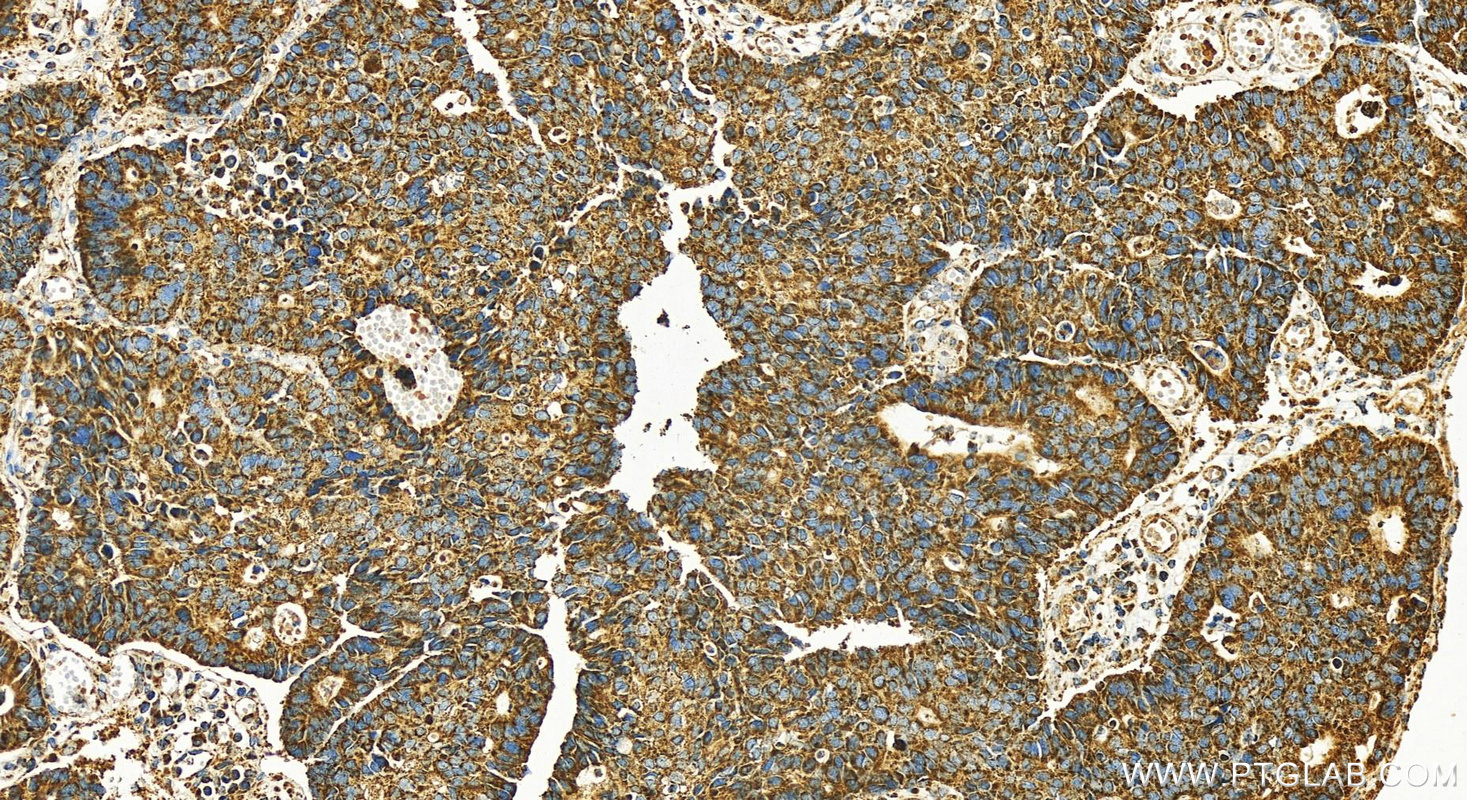 IHC staining of human stomach cancer using 28351-1-AP