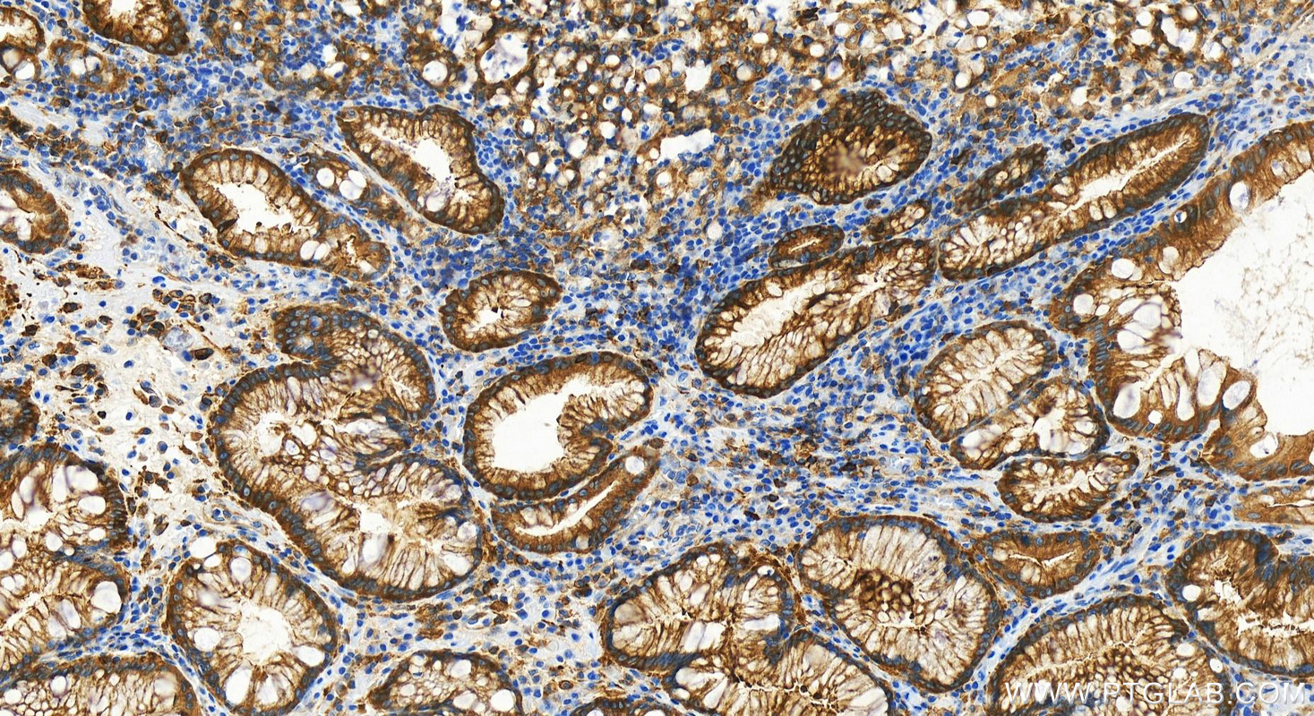 IHC staining of human stomach cancer using 83840-6-RR