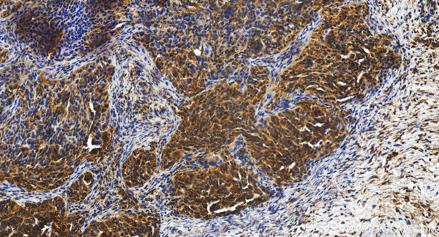 IHC staining of human ovary cancer using 14188-1-AP