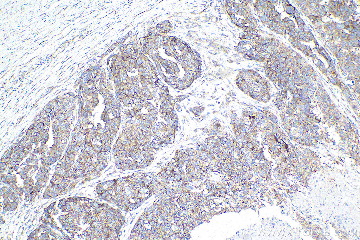 IHC staining of human ovary cancer using 68518-1-Ig