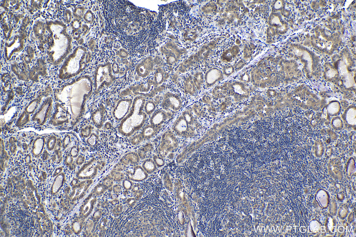 IHC staining of human thyroid cancer using 66885-1-Ig (same clone as 66885-1-PBS)