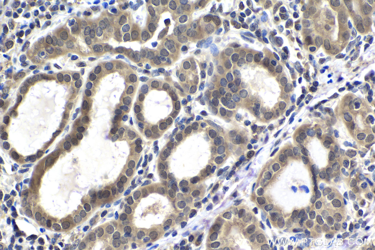 IHC staining of human thyroid cancer using 66885-1-Ig (same clone as 66885-1-PBS)