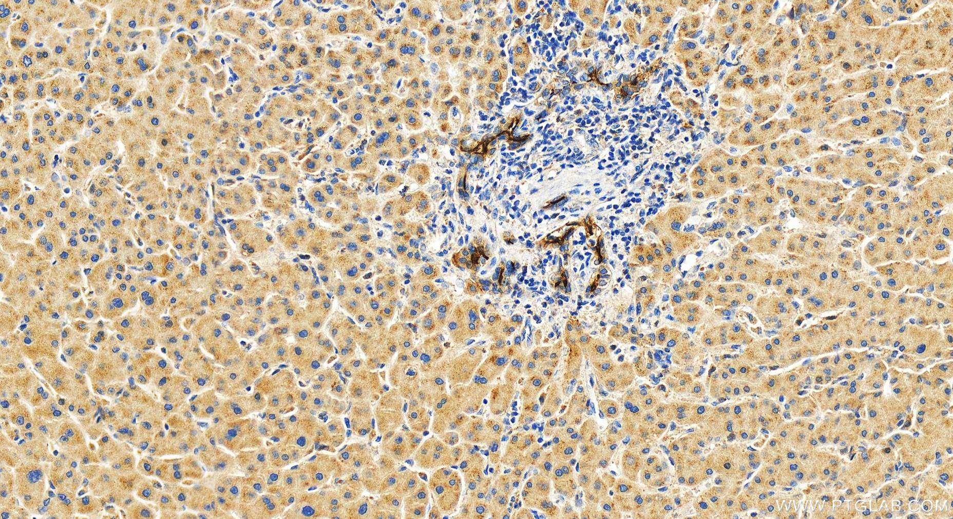 IHC staining of human intrahepatic cholangiocarcinoma using 18495-1-AP