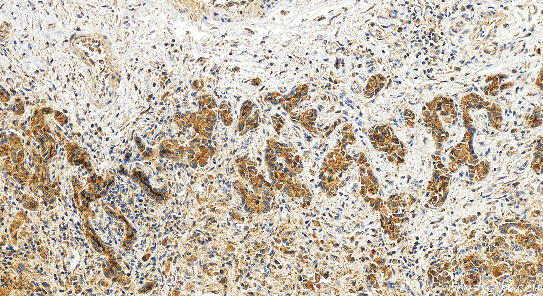 IHC staining of human intrahepatic cholangiocarcinoma using 18495-1-AP