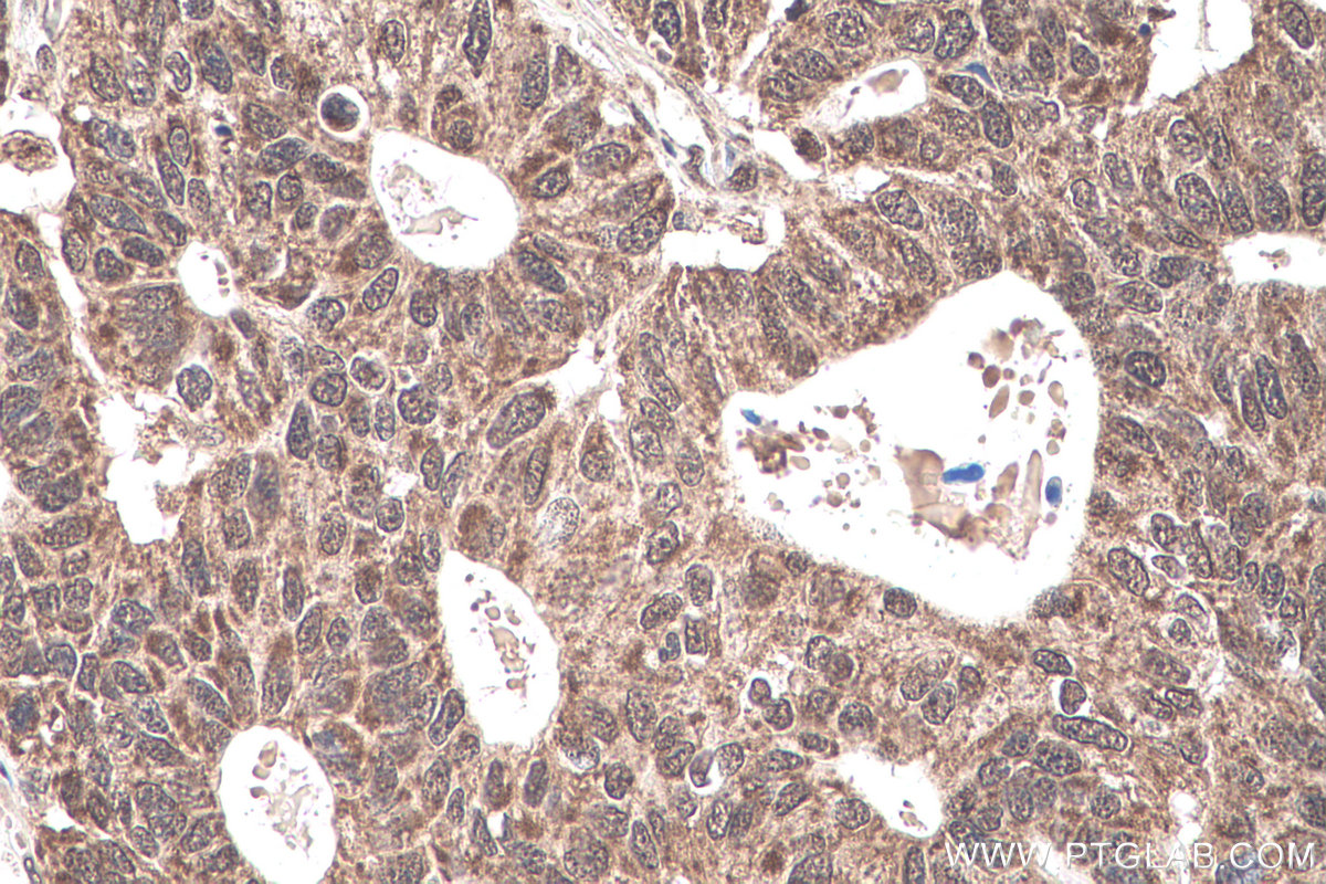 IHC staining of human stomach cancer using 11171-1-AP