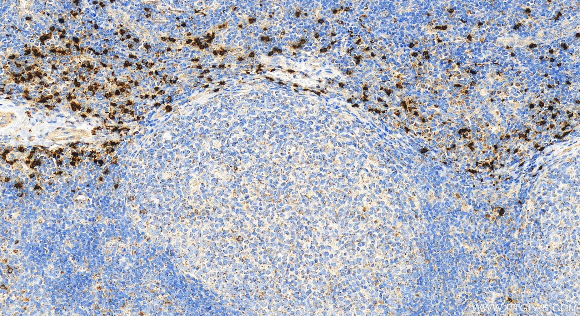 IHC staining of human tonsillitis using 27153-1-AP