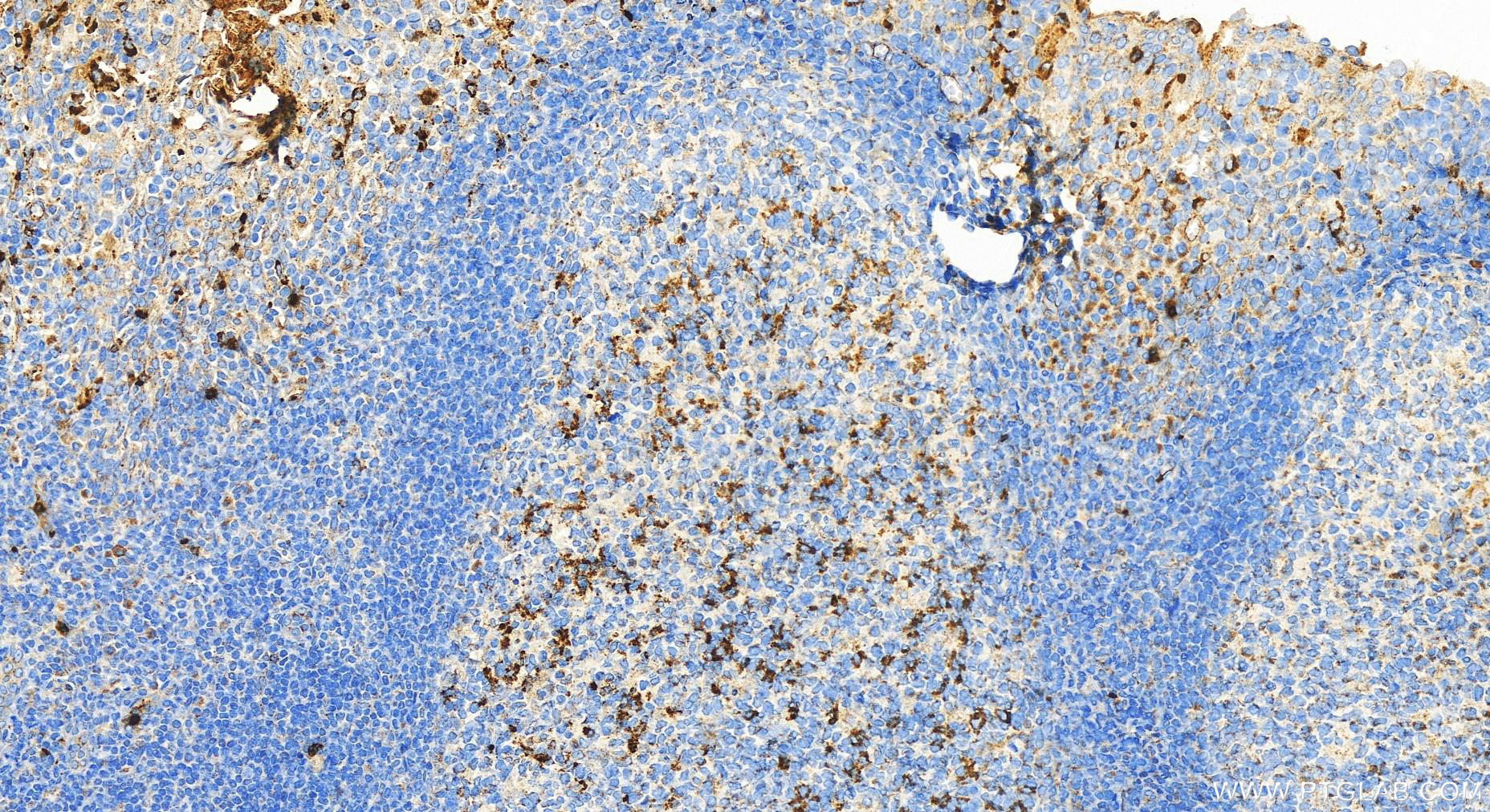 IHC staining of human tonsillitis using 27153-1-AP