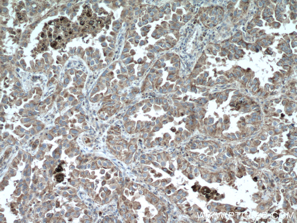 IHC staining of human lung cancer using 10664-1-AP