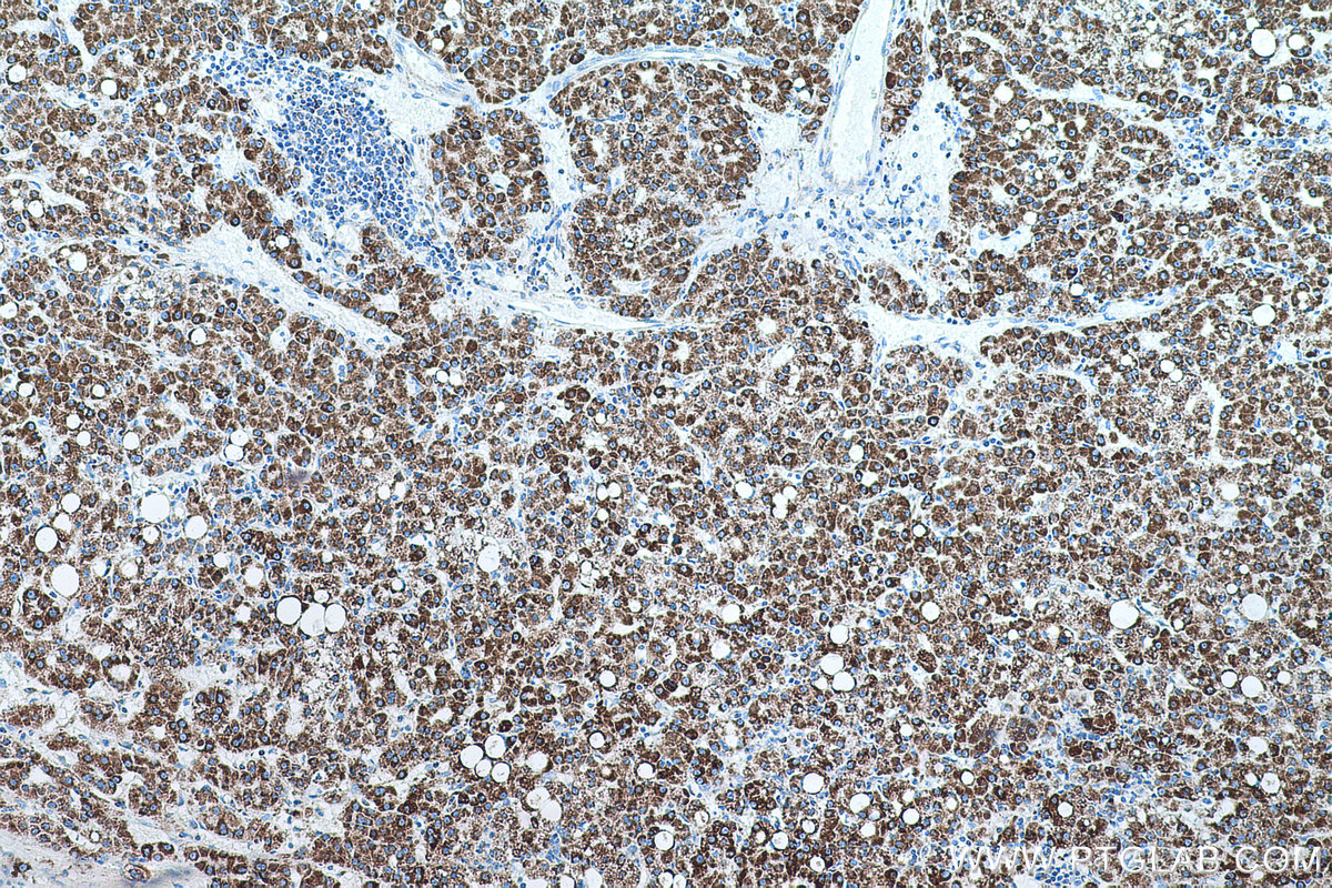 IHC staining of human liver cancer using 66810-1-Ig