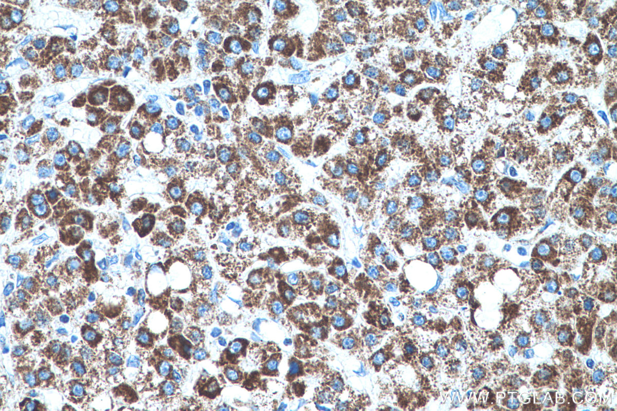 IHC staining of human liver cancer using 66810-1-Ig