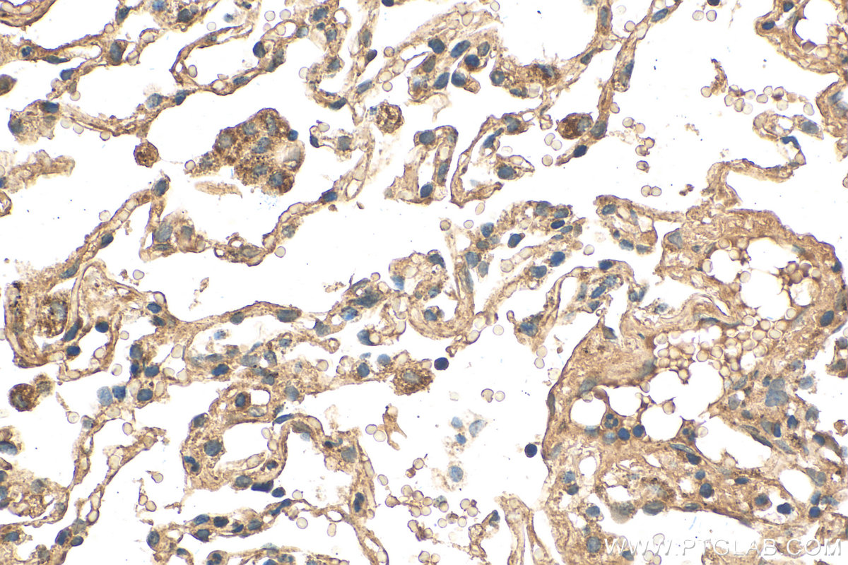 IHC staining of human lung cancer using 81833-1-RR (same clone as 81833-1-PBS)