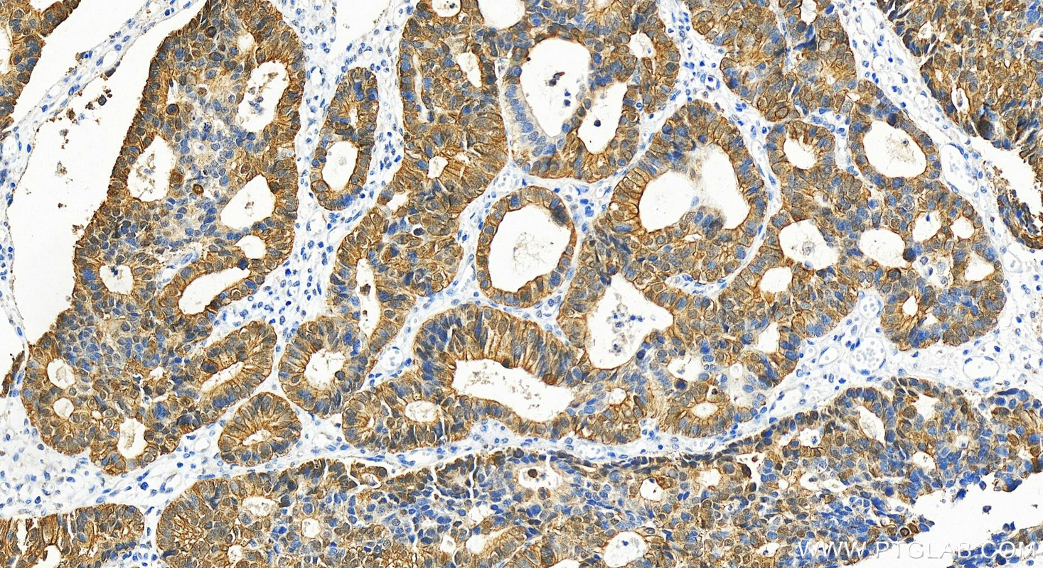 IHC staining of human stomach cancer using 55128-1-AP