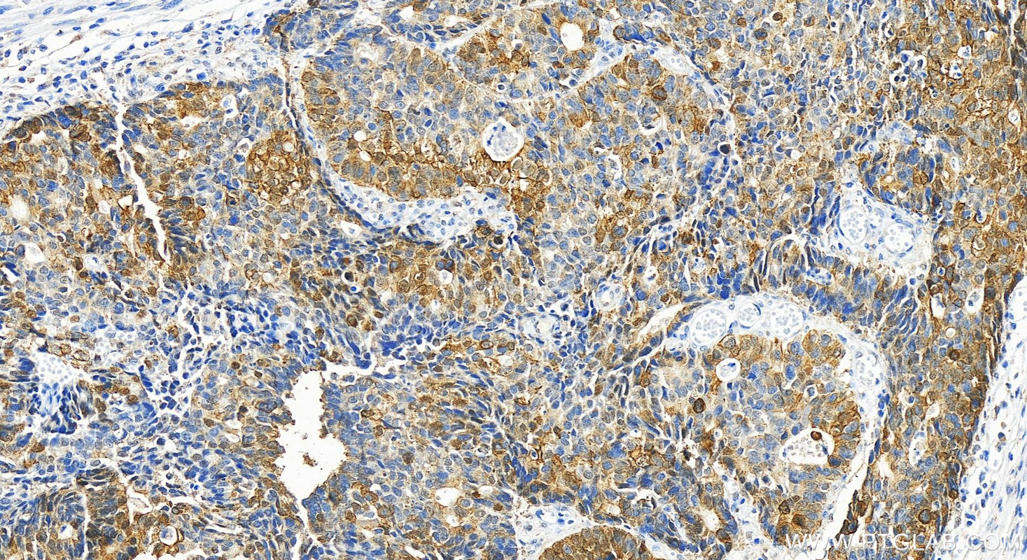 IHC staining of human stomach cancer using 55128-1-AP