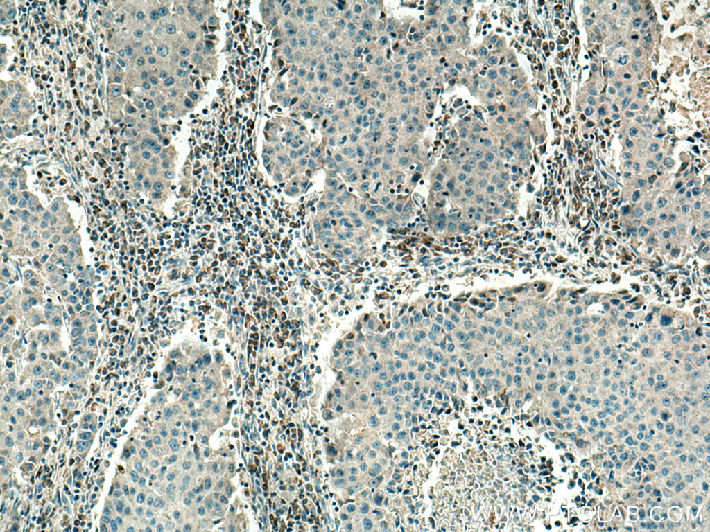 IHC staining of human breast cancer using 67619-1-Ig (same clone as 67619-1-PBS)