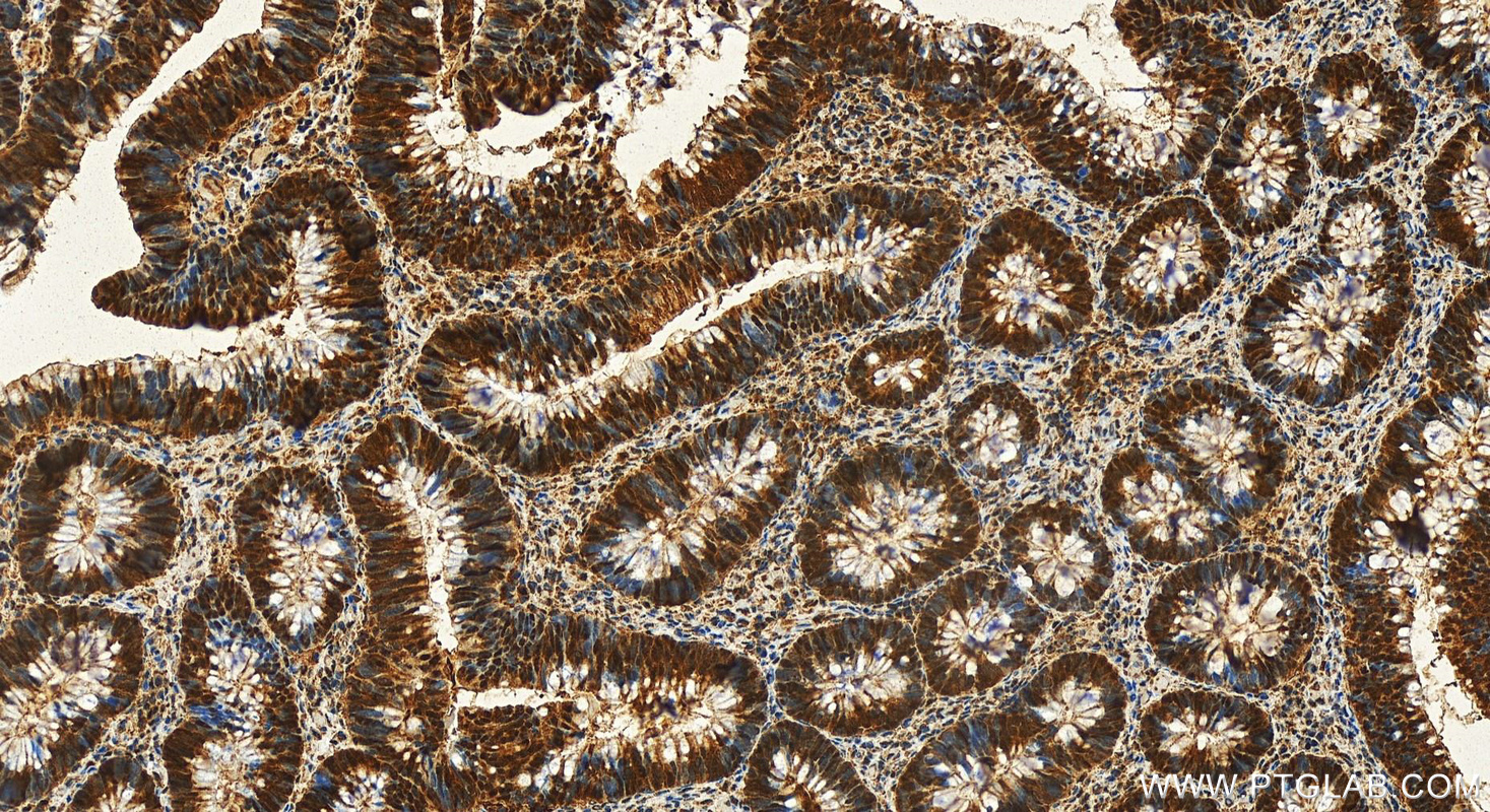 IHC staining of human colon cancer using 11175-1-AP