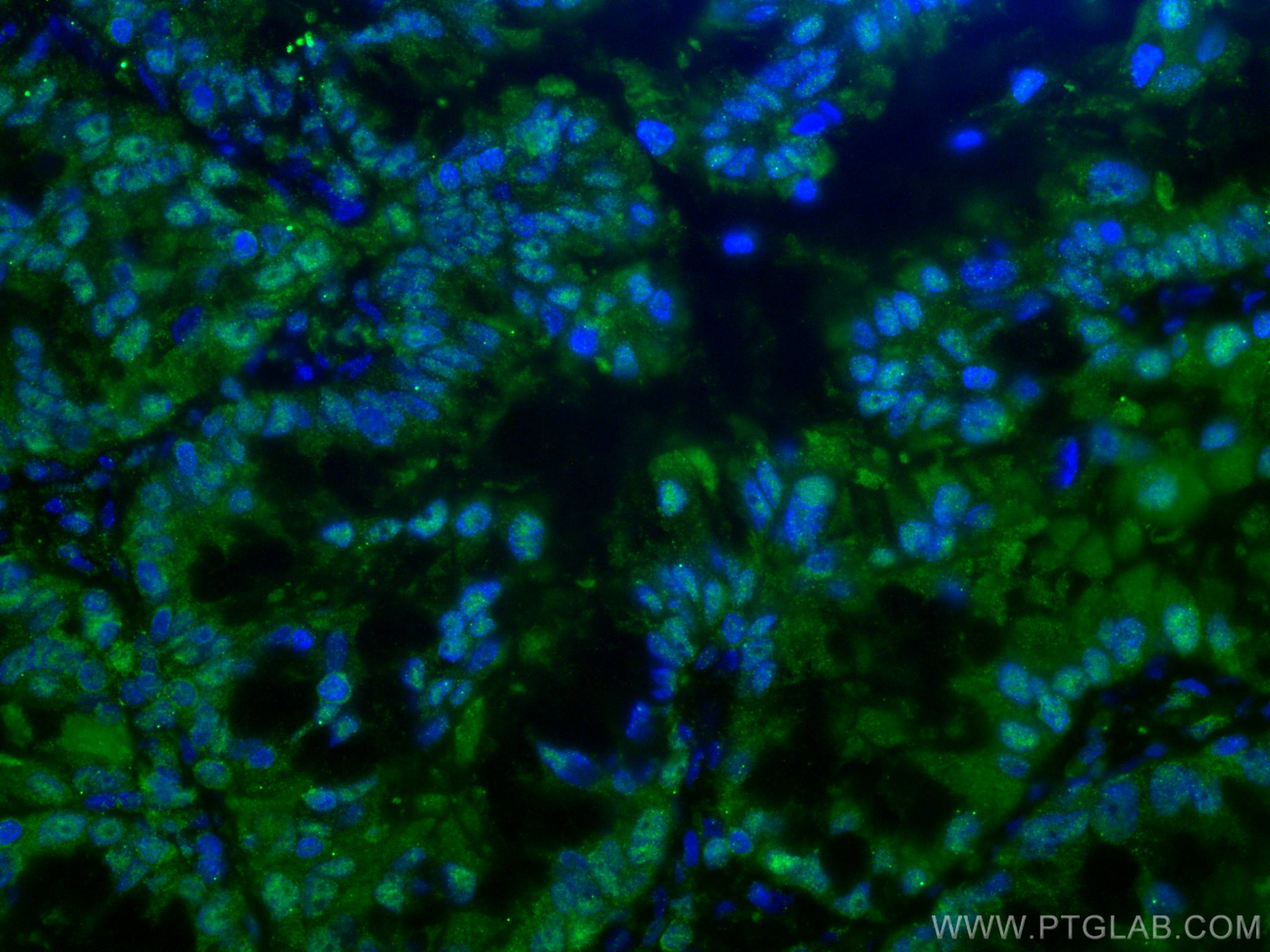 IF Staining of human lung cancer using 67695-1-Ig (same clone as 67695-1-PBS)