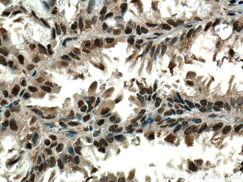 IHC staining of human lung cancer using 67695-1-Ig (same clone as 67695-1-PBS)