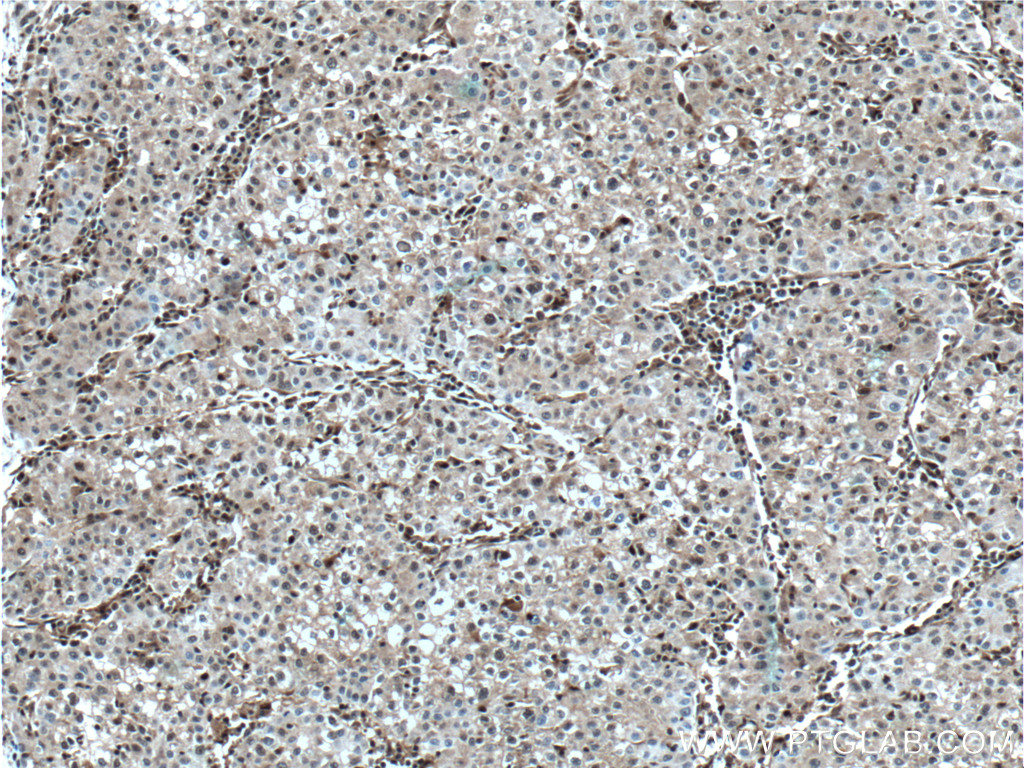 IHC staining of human liver cancer using 66403-1-Ig (same clone as 66403-1-PBS)