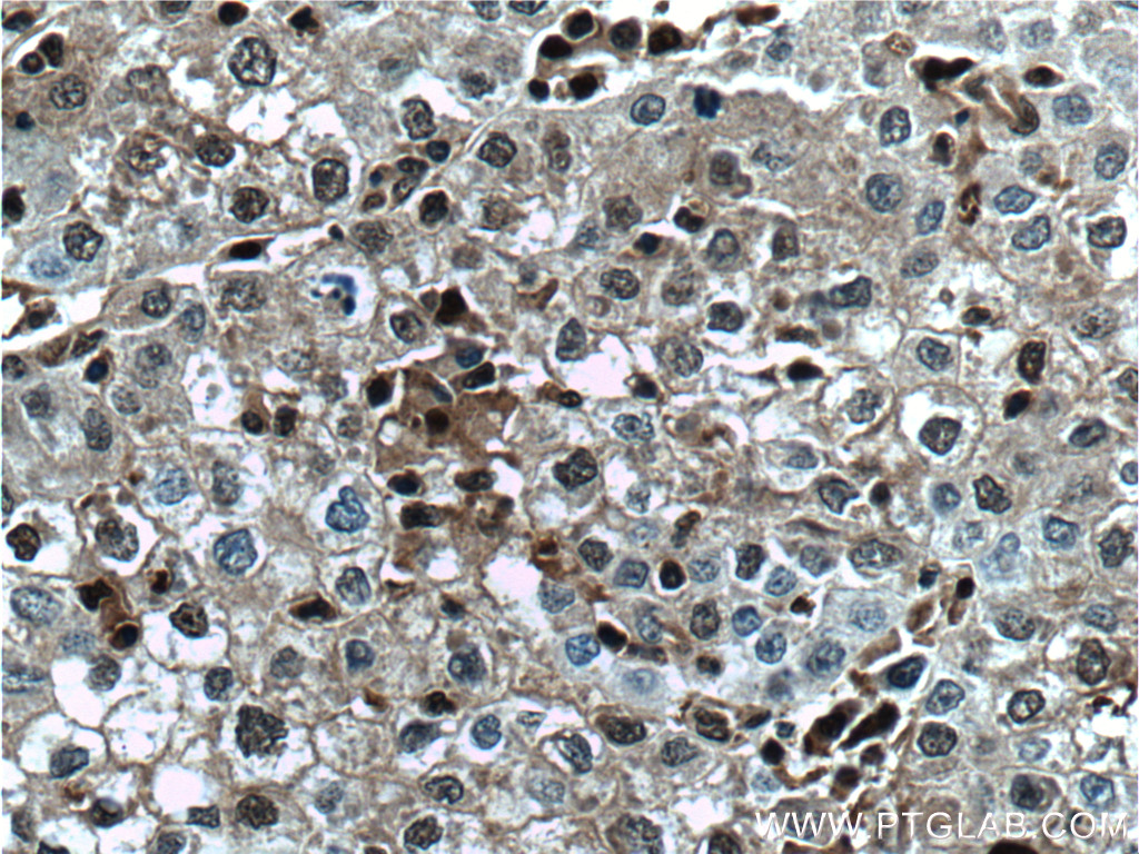 IHC staining of human liver cancer using 66403-1-Ig (same clone as 66403-1-PBS)