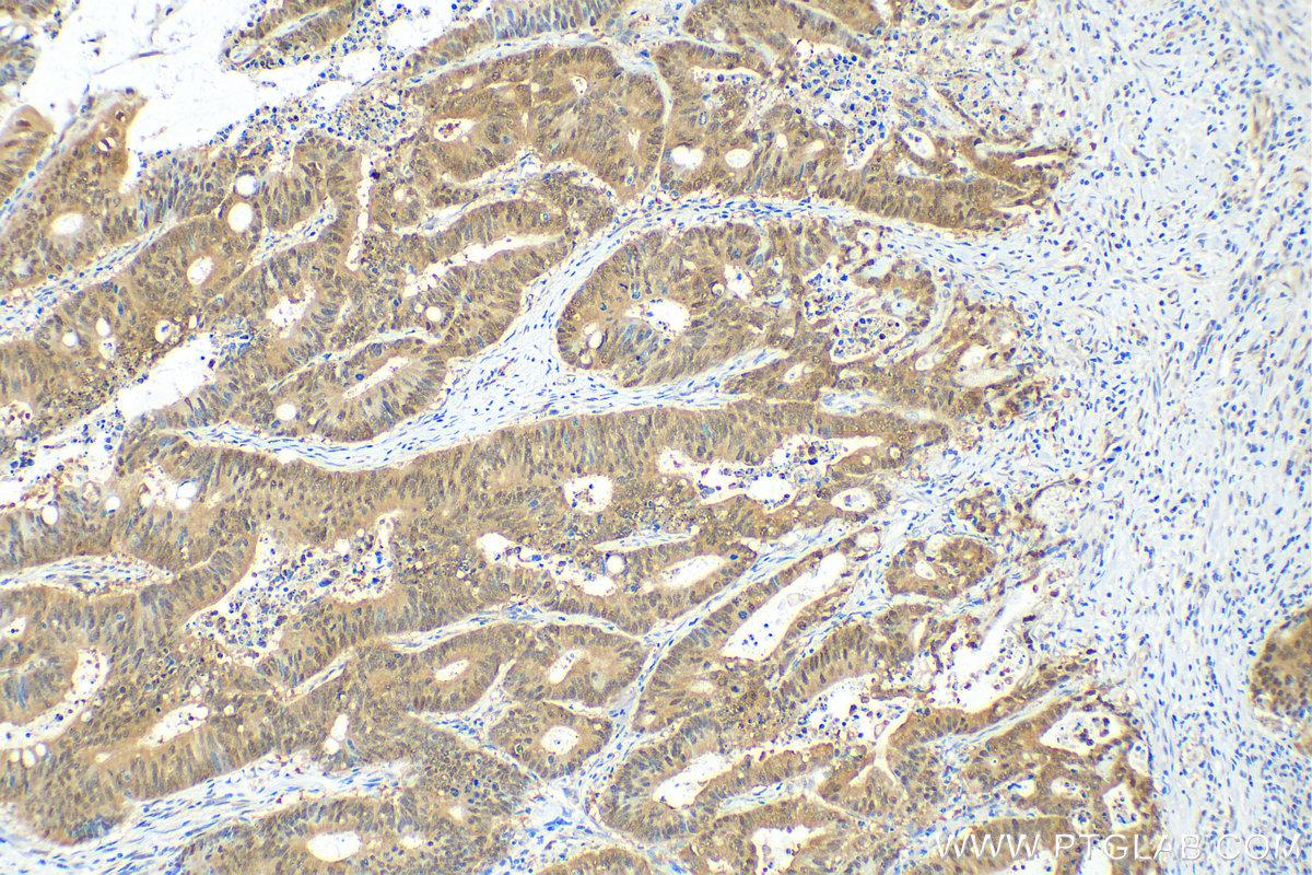 IHC staining of human colon cancer using 68641-1-Ig (same clone as 68641-1-PBS)